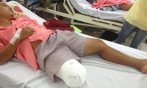 Hình ảnh chiếc chân phải bị cưa của bệnh nhân.