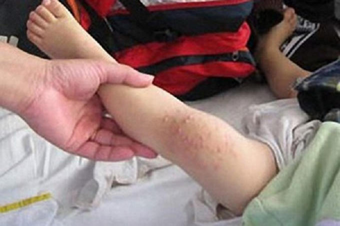 Hầu hết trẻ mắc tay chân miệng ở mức độ nhẹ nhưng một số ca gây biến chứng nguy hiểm