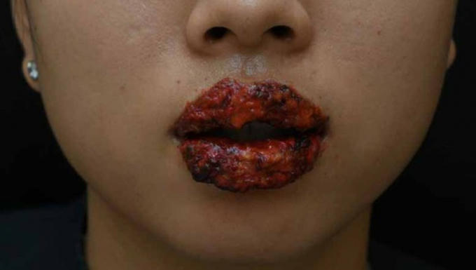 Môi bệnh nhân đóng mài dày, đau rát sau xăm (ảnh: BVCC)