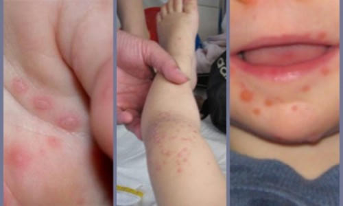 Số ca mắc tay chân miệng đang có dấu hiệu gia tăng. 