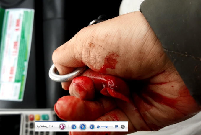 Ngón trỏ tay phải của nhà báo Đỗ Doãn Hoàng bị dập nát và bật móng sau khi bị gậy vụt vào. (Ảnh: Báo Lao động)