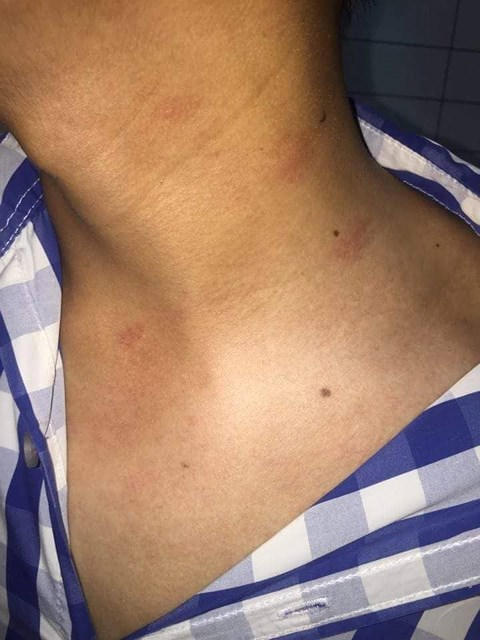 Vết tích trên cổ Nhà báo Trần Hiếu (nguồn ảnh báo Phụ Nữ Việt Nam).