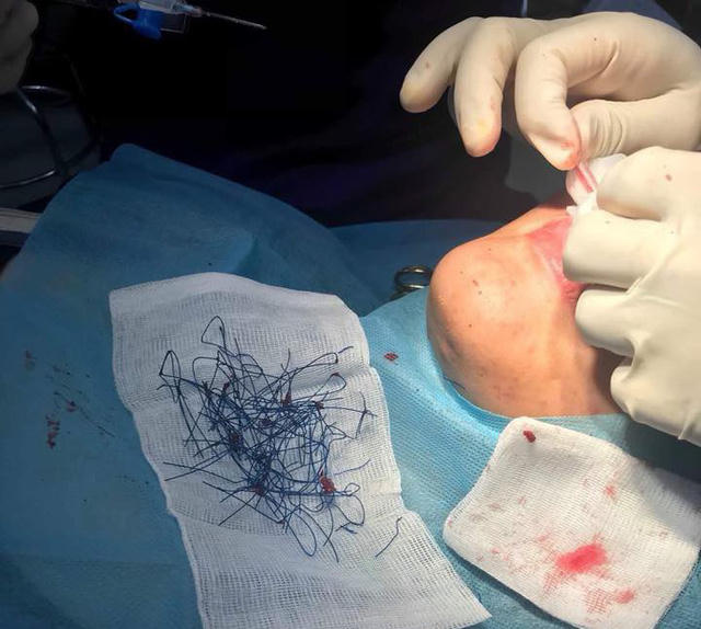 Ước tính, số đoạn chỉ cắt ra này là 20-30 đoạn (Ảnh do BS cung cấp)