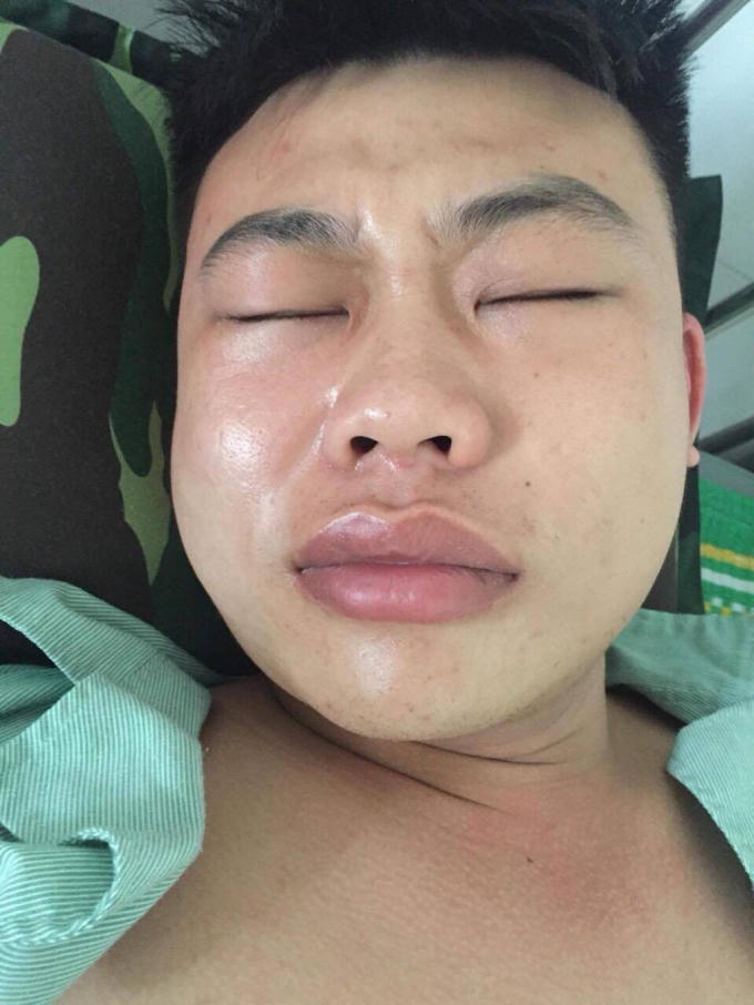 Khuôn mặt anh Chung bị sưng sau khi được đưa về nhà.