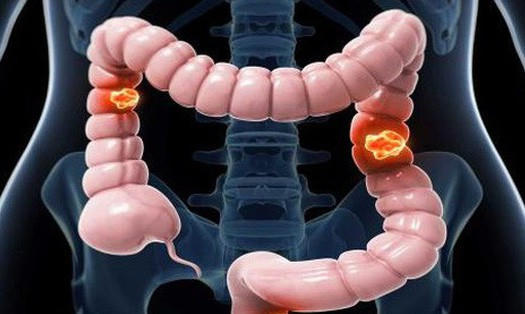 Ung thư đại tràng đe dọa tính mạng nhiều người.