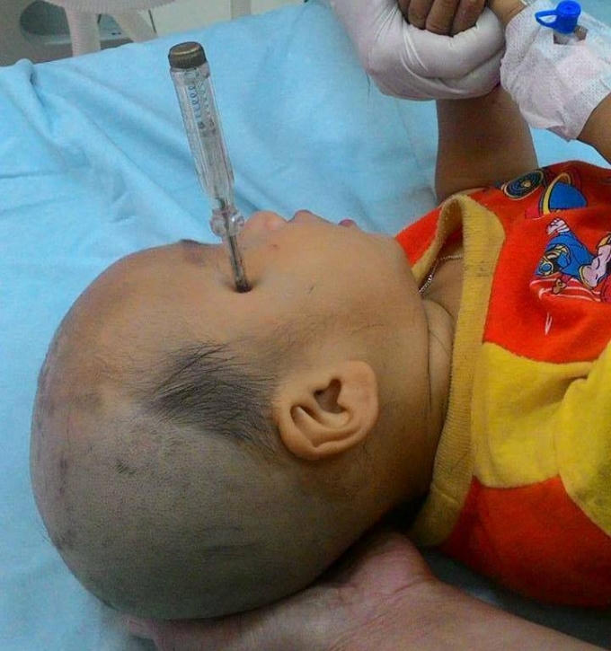 Bé Nguyễn Duy Khiêm bị tuốc nơ vít cắm vào đầu.