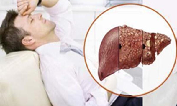 Việt Nam là nước có số người nhiễm vi rút viêm gan B cao trên thế giới. (Ảnh: minh họa)