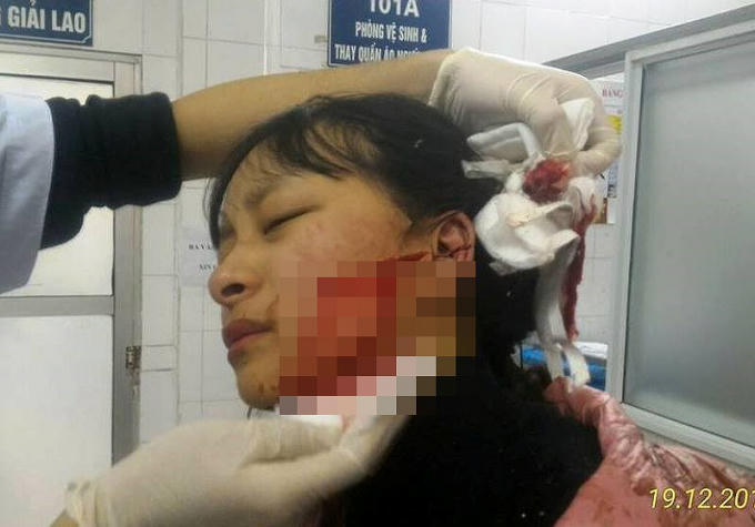 Vết khâu từ má trái lên đến tai trái của Đỗ Thị Phương L. sau khi bị người tên Vân chủ cửa hàng đối diện tấn công. Ảnh: Gia đình cung cấp.