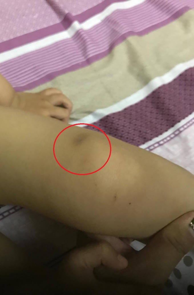 Ngoài vết đỏ trên tai N.K, chị S. còn phát hiện thêm vết bầm trên chân cháu. Ảnh: NVCC.