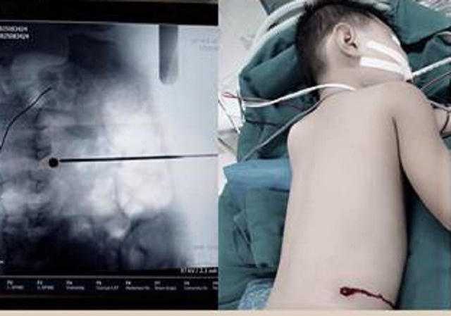 Viên đạn đi vào đường hông - lưng găm vào ngay cột sống. Ảnh: BVCC