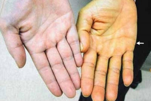 Khi đến, ở trong vùng dịch tại các nước đang có dịch cần chủ động thực hiện các biện pháp xua muỗi và phòng phòng muỗi đốt. Ảnh: minh họa/Nguồn: suckhoedoisong.vn