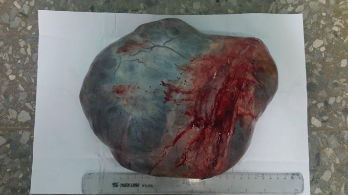 Khối u khủng có trọng lượng hơn 4kg được lấy ra từ bụng cụ bà.