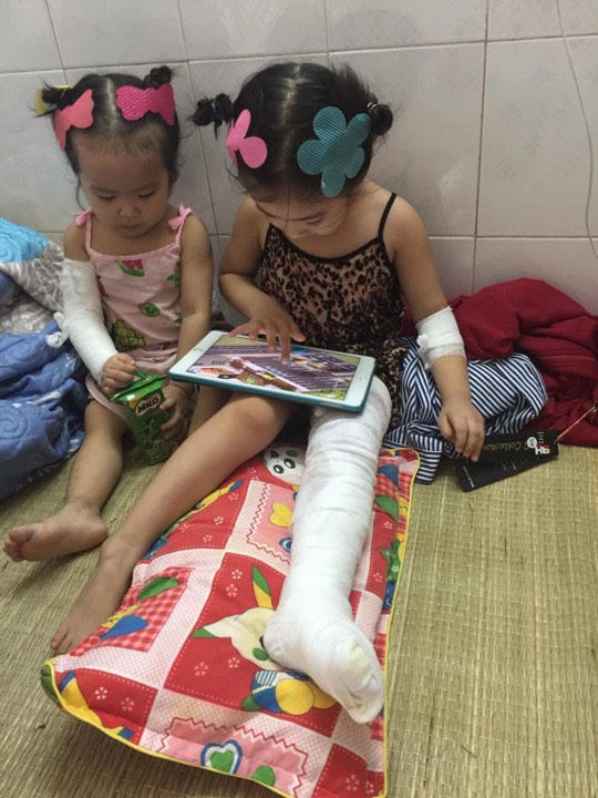Hai cháu Linh Đan 4 tuổi và Linh Nhi 2 tuổi vừa được các bác sỹ bệnh viện Bỏng trung ương cấy ghép da.