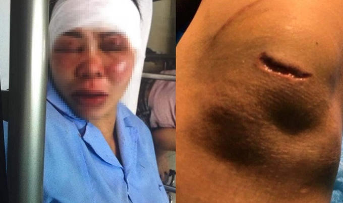 Chị H. bị chồng hành hung gây thương tích phải nhập viện.