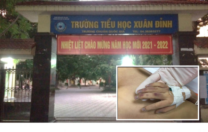 Khởi tố người bố vụ bạo hành con 6 tuổi.