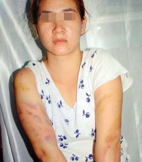 Chị Mơ với những vết thương do Pháp đánh.