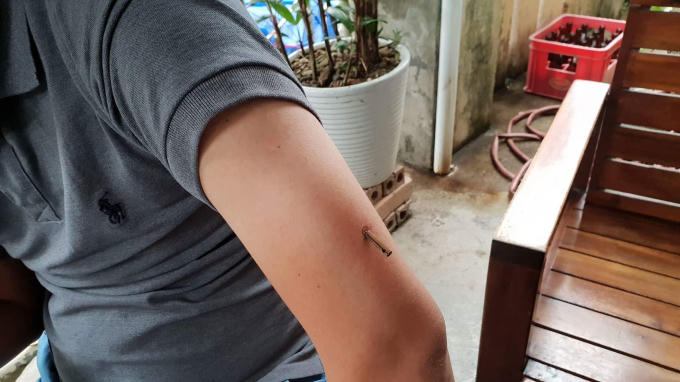 Viên đạn găm vào tay anh Thành.