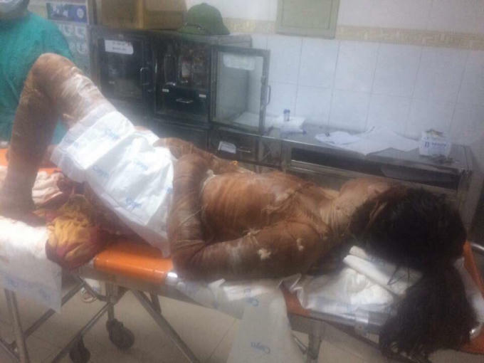 Mức độ bỏng của chị M. là 65% cơ thể.