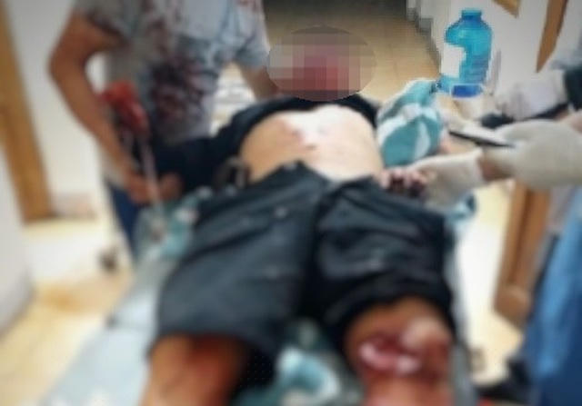 Nạn nhân được đưa vào nhập viện trong tình trạng chấn thương nặng.