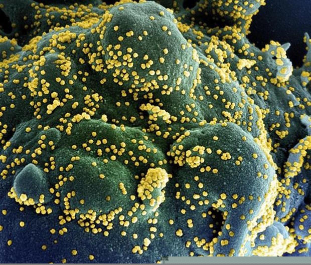 Một tế bào (xanh dương/xanh lục) bị nhiễm nặng các hạt virus SARS-CoV-2 (màu vàng), được phân lập từ mẫu của bệnh nhân COVID-19. (Ảnh: AFP/TTXVN)