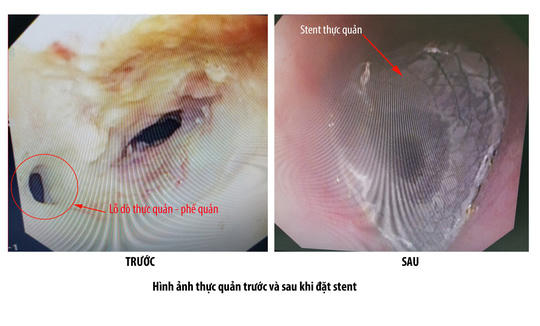 Hình ảnh trước và sau khi đặt stent thực quản cho bệnh nhân B. Ảnh: PHƯƠNG CHI