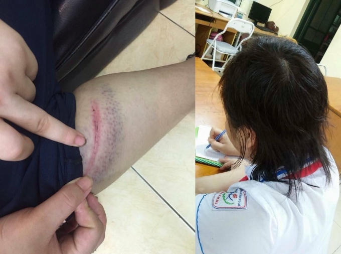 Vết bầm tím của cháu L.A và mái tóc bị cắt nham nhở.
