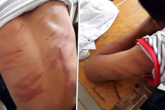 Người cháu L đầy thương tích sau khi bị bố đánh.