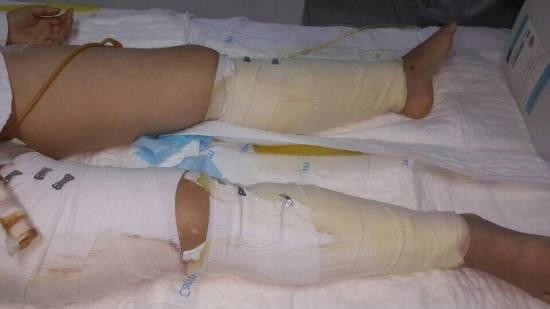 Hai chân của bệnh nhân Thoa đang phục hồi tốt. (Ảnh: Suckhoedoisong.vn)