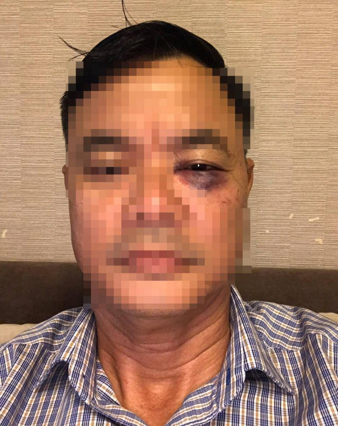 Ông Hùng bị nhóm côn đồ đuổi đánh gây thương tích đầy mặt.