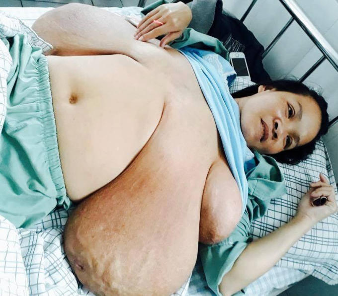 Hiện chị Hà Thị Tuyên đang điều trị tại Khoa Ung Bướu Bệnh viện ĐK Phú Thọ. Ảnh: FB