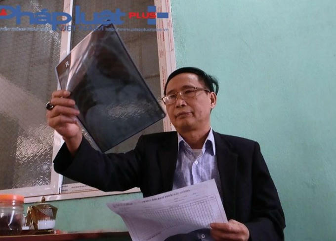 Ông Đỗ Văn Khang đang đọc bệnh ung thư phổi từ phim chụp (Ảnh: Tiến Vũ)