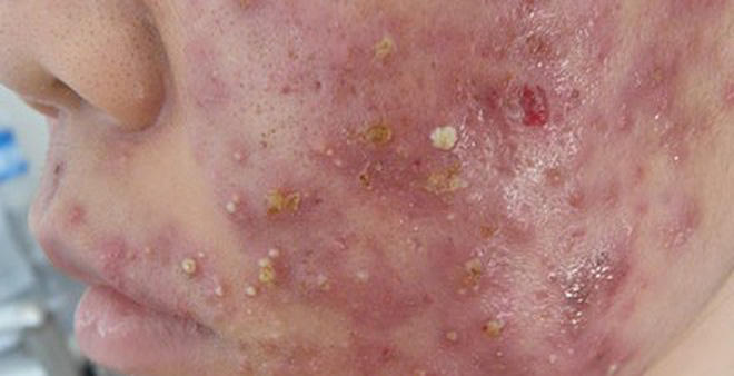 Ảnh minh họa: Một nạn nhân bị dị ứng khi dùng kem trộn. (Nguồn Báo mới)