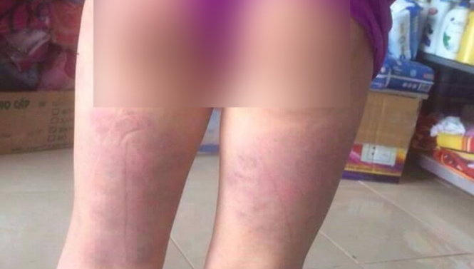 Vết thương bầm tím ở vùng mông đến ngót chân của M. sau khi bị cô giáo dùng thước đánh. (Ảnh: Trung Nguyễn/Tuổi trẻ)