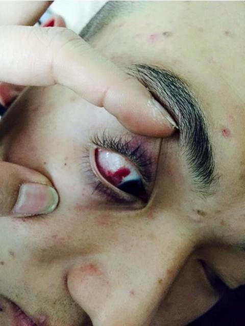 Một vết thương trong số nhiều vết thương trên cơ thể Hưng.