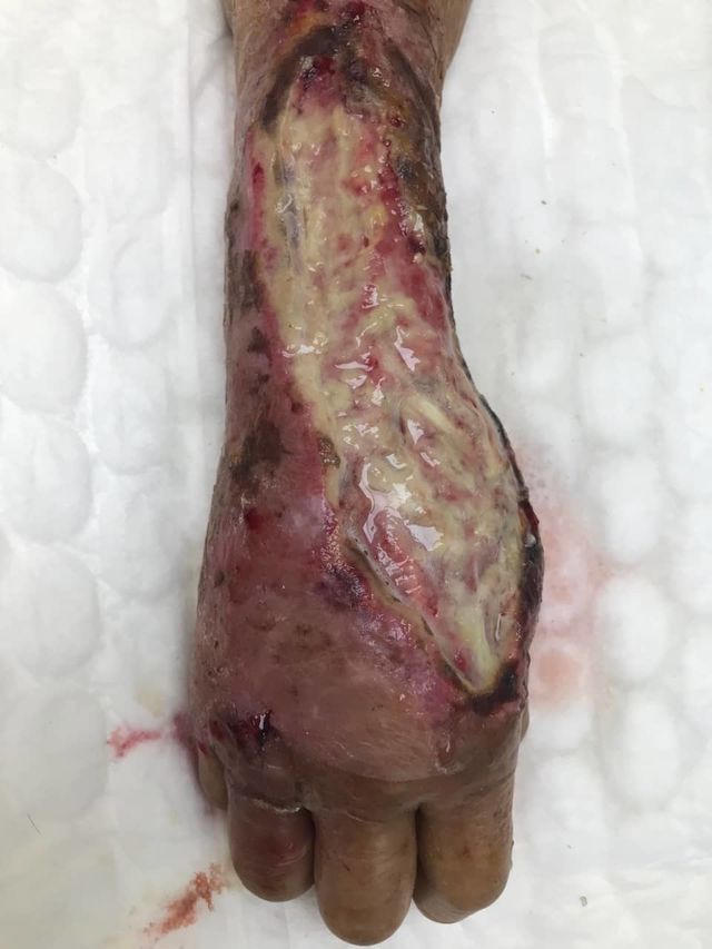 Tay của nạn nhân bị hoại tử khi nhập viện