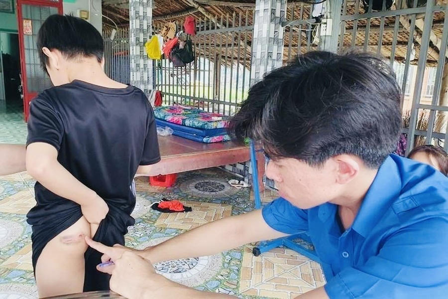 Một trong 5 người dân bị chó dại cắn tại huyện Nhơn Trạch. (Ảnh: HAC)
