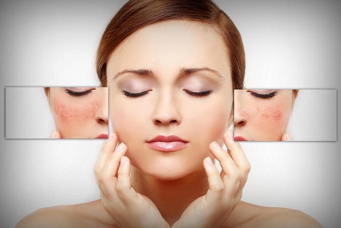 Viên uống trắng da, trị nám Gluta White Plus có gây tác dụng phụ không?