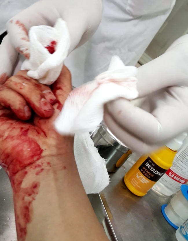 Ngón tay trỏ của Nhà báo Đỗ Doãn Hoàng bị các đối tượng đánh dập, gãy.