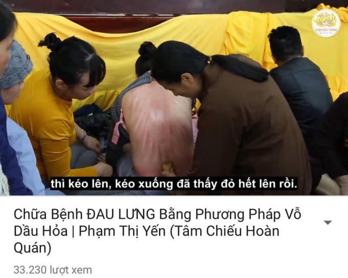 Cơ thể vỗ và cạo đến tím tái.