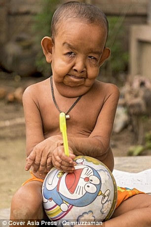 Cậu b&eacute; 4 tuổi mang ngoại h&igrave;nh &ocirc;ng l&atilde;o 80 v&igrave; mắc bệnh lạ