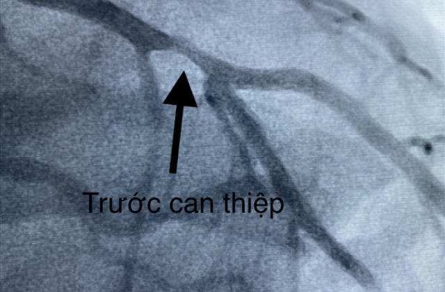 Ngưng tim 90 phút, một bác sĩ ở Cần Thơ được cứu sống thần kì