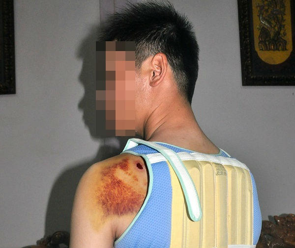 Nạn nhân bị đánh trọng thương cột sống, phải nẹp y tế.