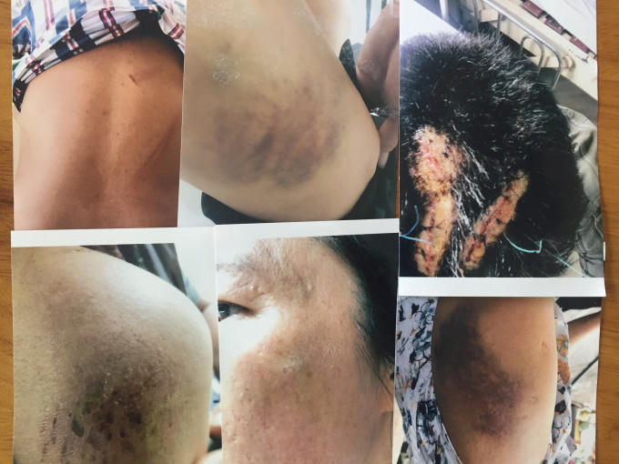Nhiều người trong gia đình bà Ba bị thương tích do các đối tượng gây ra.