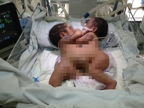 Hình ảnh hai bé dính liền vào nhau. (Ảnh: Zing News)