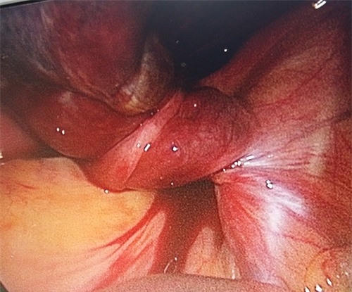 U nang buồng trứng xoắn là một trong những biến chứng thường gặp.