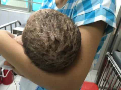 Sau 5 ngày được chăm sóc, các tổn thương của bé đã khô lại và bắt đầu bong vảy. Ảnh: Bệnh viện Nhi Trung ương