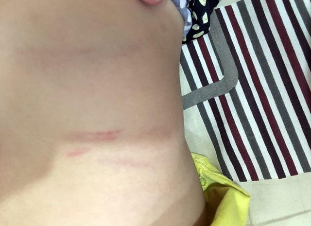 Hình ảnh cháu P. bị cô đánh thâm bầm, trầy xước (ảnh do gia đình cung cấp)