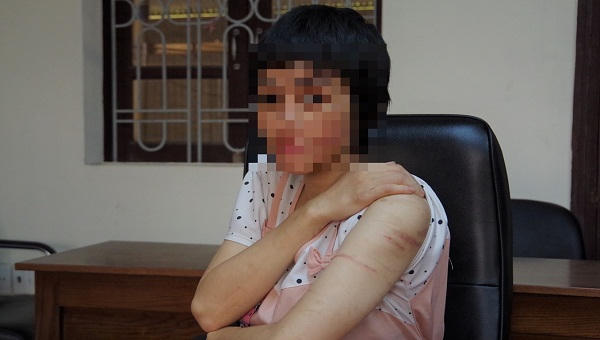 Tỷ lệ thương tích của chị T.G là 29%.