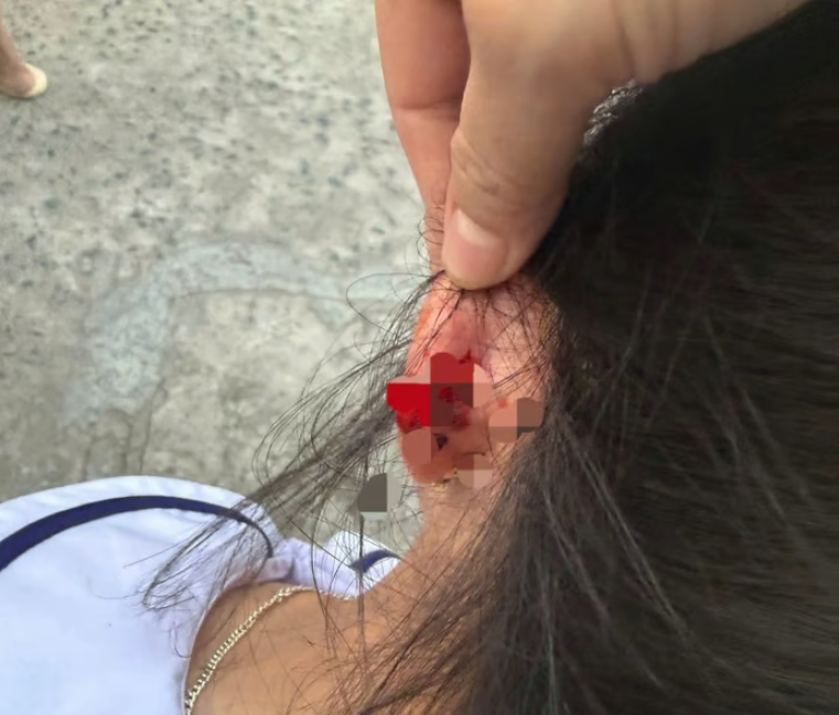 Hình ảnh em K. được cho là bị cô giáo nhéo chảy máu tai đăng trên mạng xã hội.