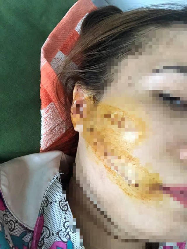 Hình ảnh chị L. bị chồng truy phải vá hàng chục mũi trên khuôn mặt